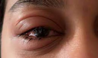 आइ फ्लू के चपेट में आने से क्षेत्र में दहशत का माहौल.....